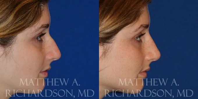 Non Surgical Nose Before and After photo by Texas Facial Aesthetics in Frisco, TX