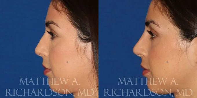 Non Surgical Nose Before and After photo by Texas Facial Aesthetics in Frisco, TX