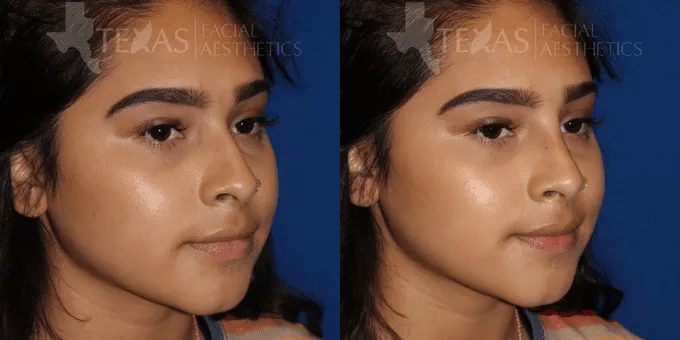 Non Surgical Nose Before and After photo by Texas Facial Aesthetics in Frisco, TX