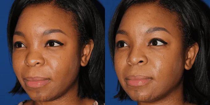 Non Surgical Nose Before and After photo by Texas Facial Aesthetics in Frisco, TX