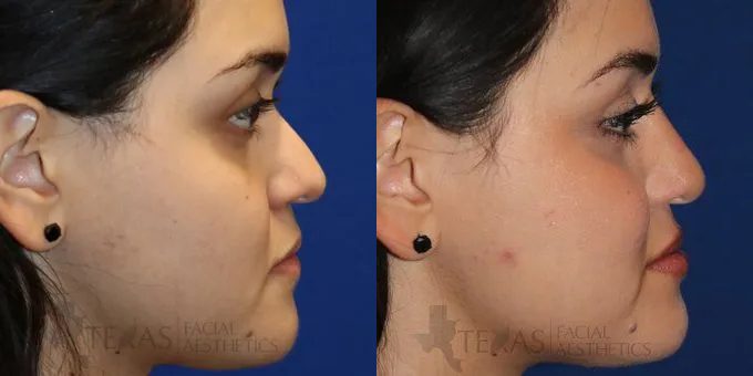 Non Surgical Nose Before and After photo by Texas Facial Aesthetics in Frisco, TX