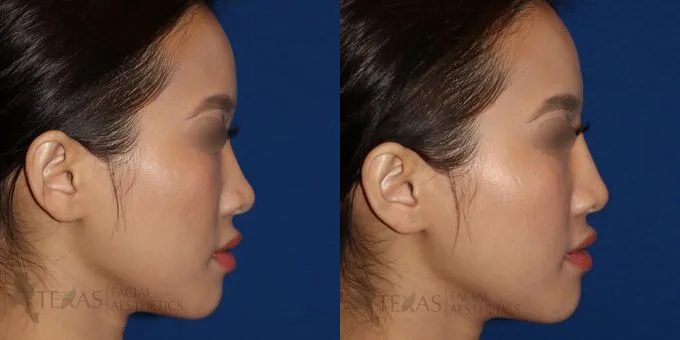 Non Surgical Nose Before and After photo by Texas Facial Aesthetics in Frisco, TX