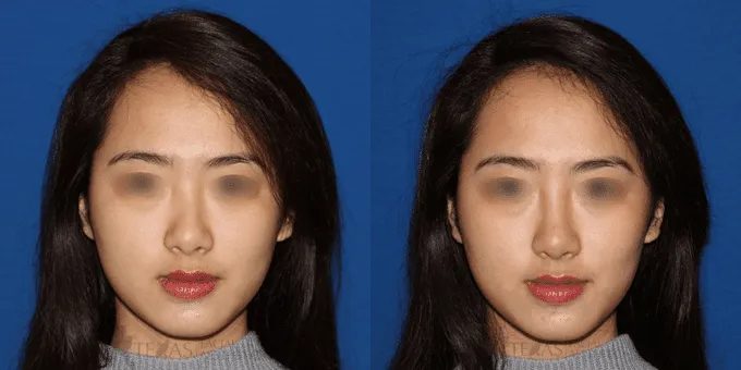 Non Surgical Nose Before and After photo by Texas Facial Aesthetics in Frisco, TX