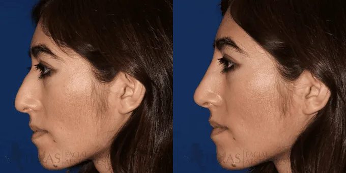 Non Surgical Nose Before and After photo by Texas Facial Aesthetics in Frisco, TX