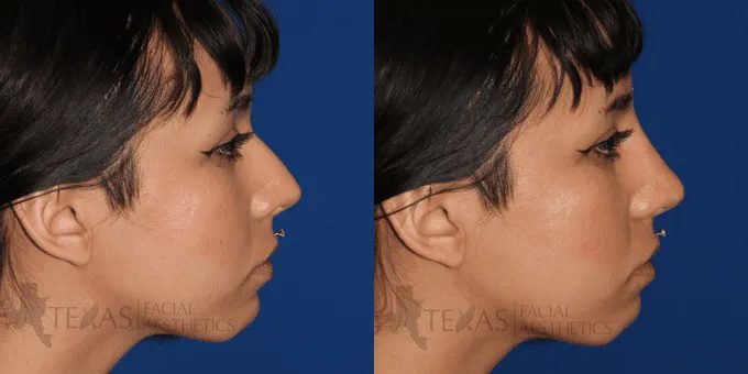 Non Surgical Nose Before and After photo by Texas Facial Aesthetics in Frisco, TX