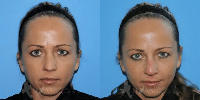 Non Surgical Nose Before and After photo by Texas Facial Aesthetics in Frisco, TX