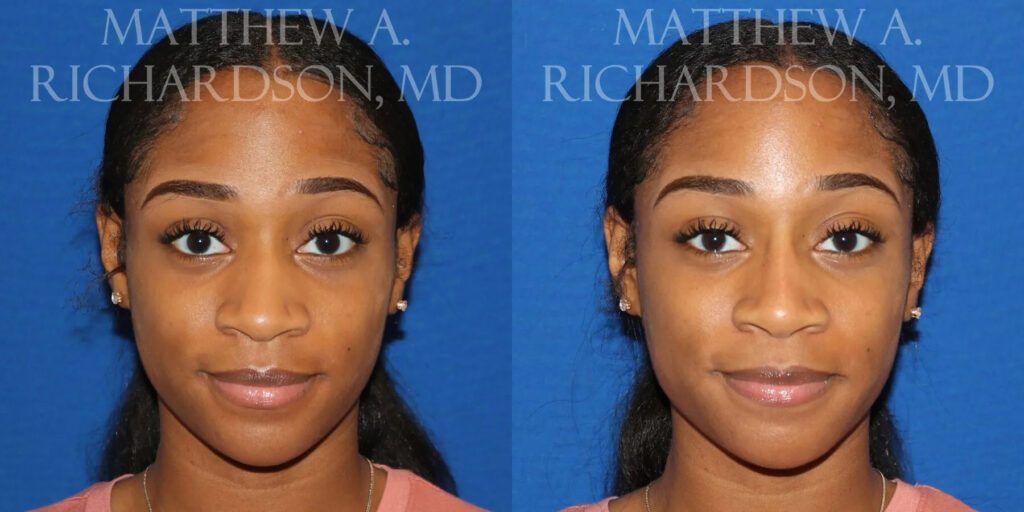 Non Surgical Nose Before and After photo by Texas Facial Aesthetics in Frisco, TX