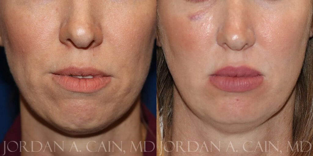 Injectable Fillers Before and After photo by Texas Facial Aesthetics in Frisco, TX