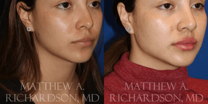 Injectable Fillers Before and After photo by Texas Facial Aesthetics in Frisco, TX