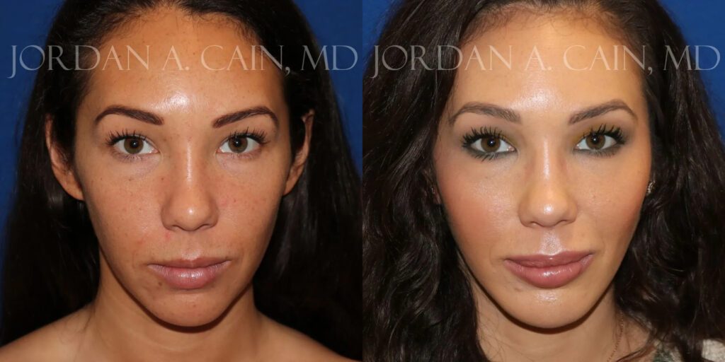 Injectable Fillers Before and After photo by Texas Facial Aesthetics in Frisco, TX