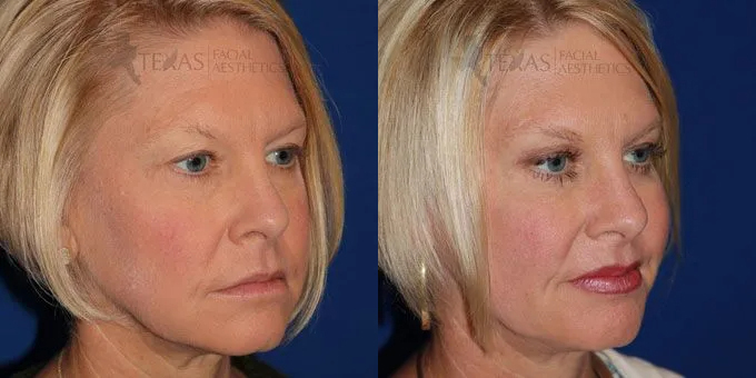 Injectable Fillers Before and After photo by Texas Facial Aesthetics in Frisco, TX