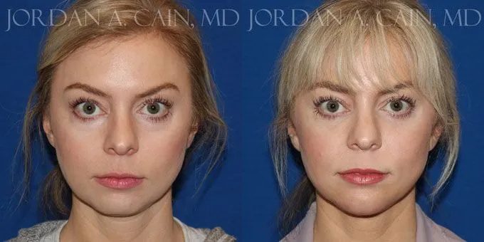 Injectable Fillers Before and After photo by Texas Facial Aesthetics in Frisco, TX