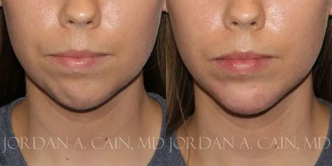 Injectable Fillers Before and After photo by Texas Facial Aesthetics in Frisco, TX