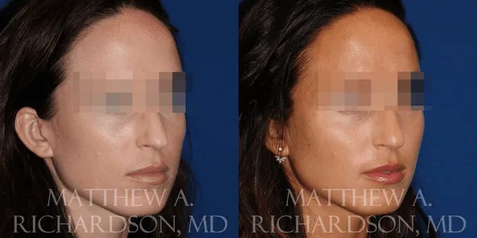 Injectable Fillers Before and After photo by Texas Facial Aesthetics in Frisco, TX