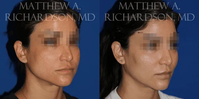 Injectable Fillers Before and After photo by Texas Facial Aesthetics in Frisco, TX