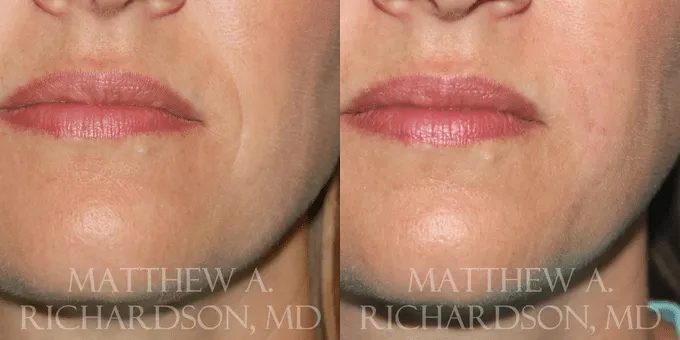 Injectable Fillers Before and After photo by Texas Facial Aesthetics in Frisco, TX