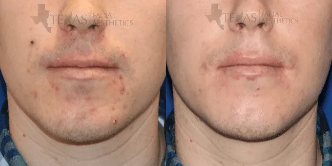 Injectable Fillers Before and After photo by Texas Facial Aesthetics in Frisco, TX