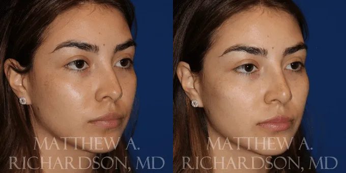 Injectable Fillers Before and After photo by Texas Facial Aesthetics in Frisco, TX