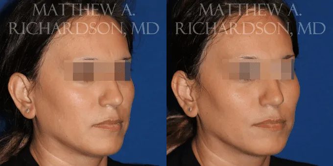 Injectable Fillers Before and After photo by Texas Facial Aesthetics in Frisco, TX