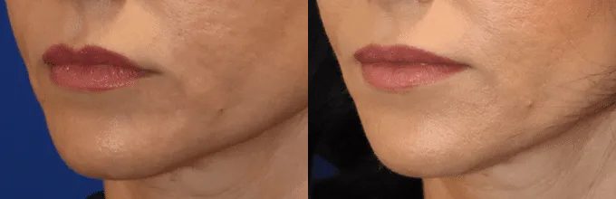 Injectable Fillers Before and After photo by Texas Facial Aesthetics in Frisco, TX