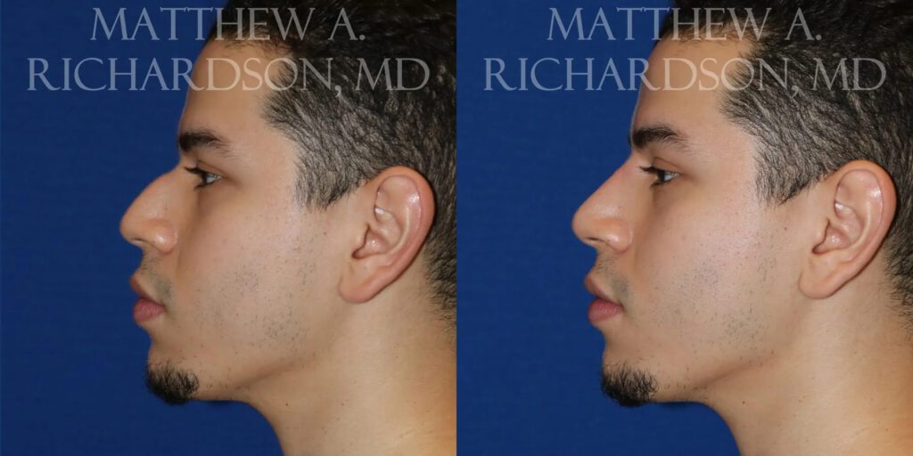 Injectable Fillers Before and After photo by Texas Facial Aesthetics in Frisco, TX