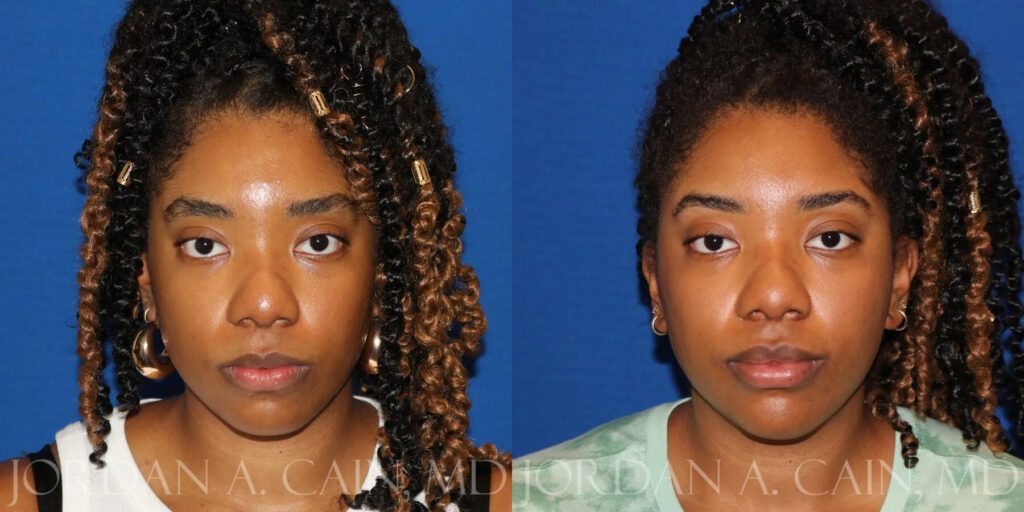 Injectable Fillers Before and After photo by Texas Facial Aesthetics in Frisco, TX