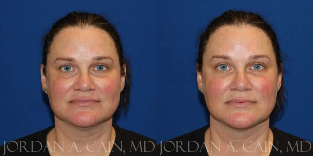 Injectable Fillers Before and After photo by Texas Facial Aesthetics in Frisco, TX