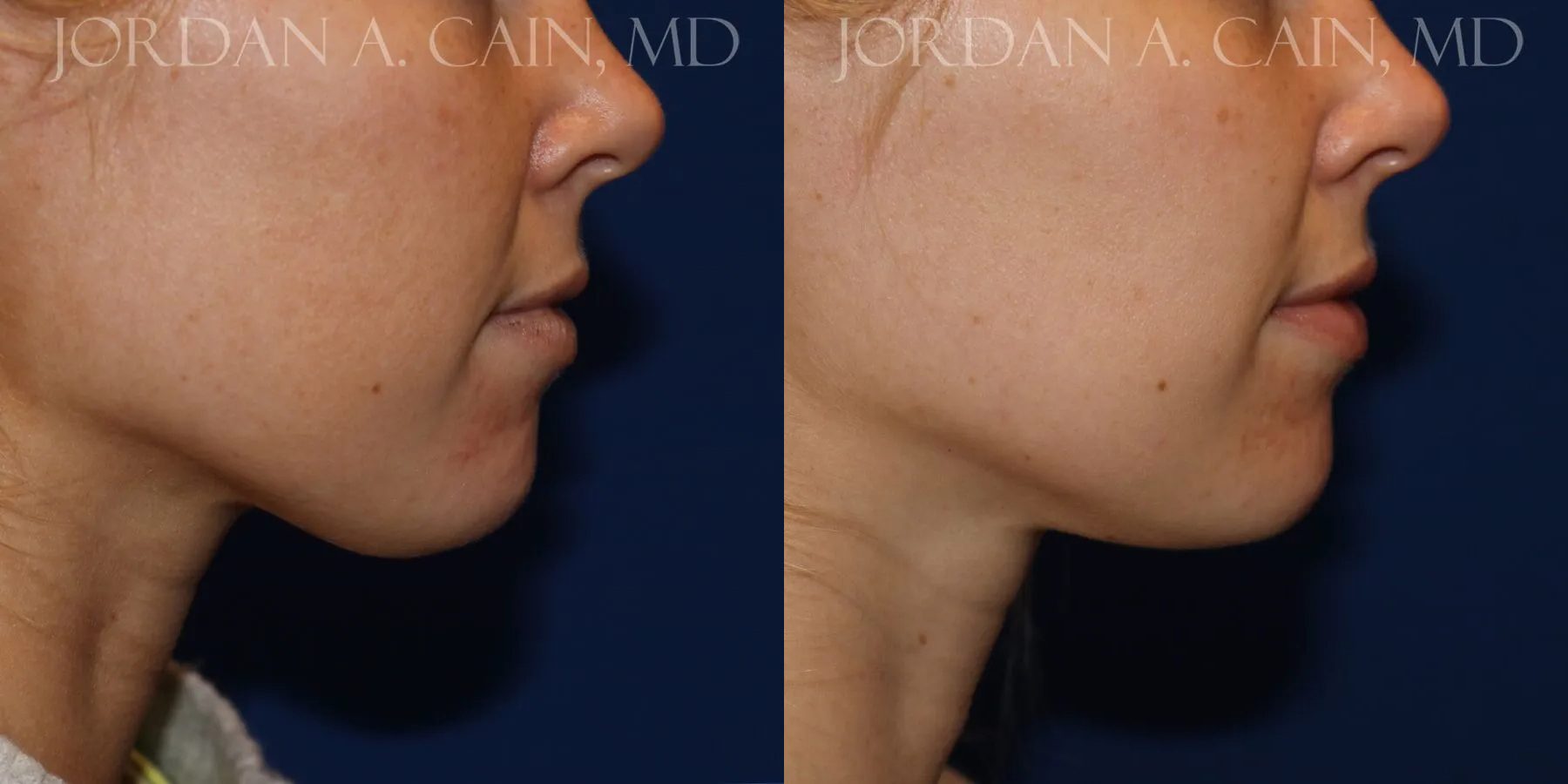 Botox Before and After photo by Texas Facial Aesthetics in Frisco, TX Botox Before and After photo by Texas Facial Aesthetics in Frisco, TX