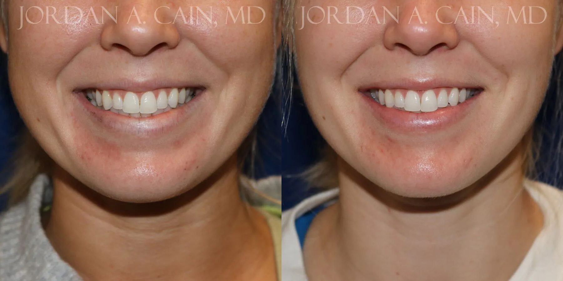 Botox Before and After photo by Texas Facial Aesthetics in Frisco, TX Botox Before and After photo by Texas Facial Aesthetics in Frisco, TX