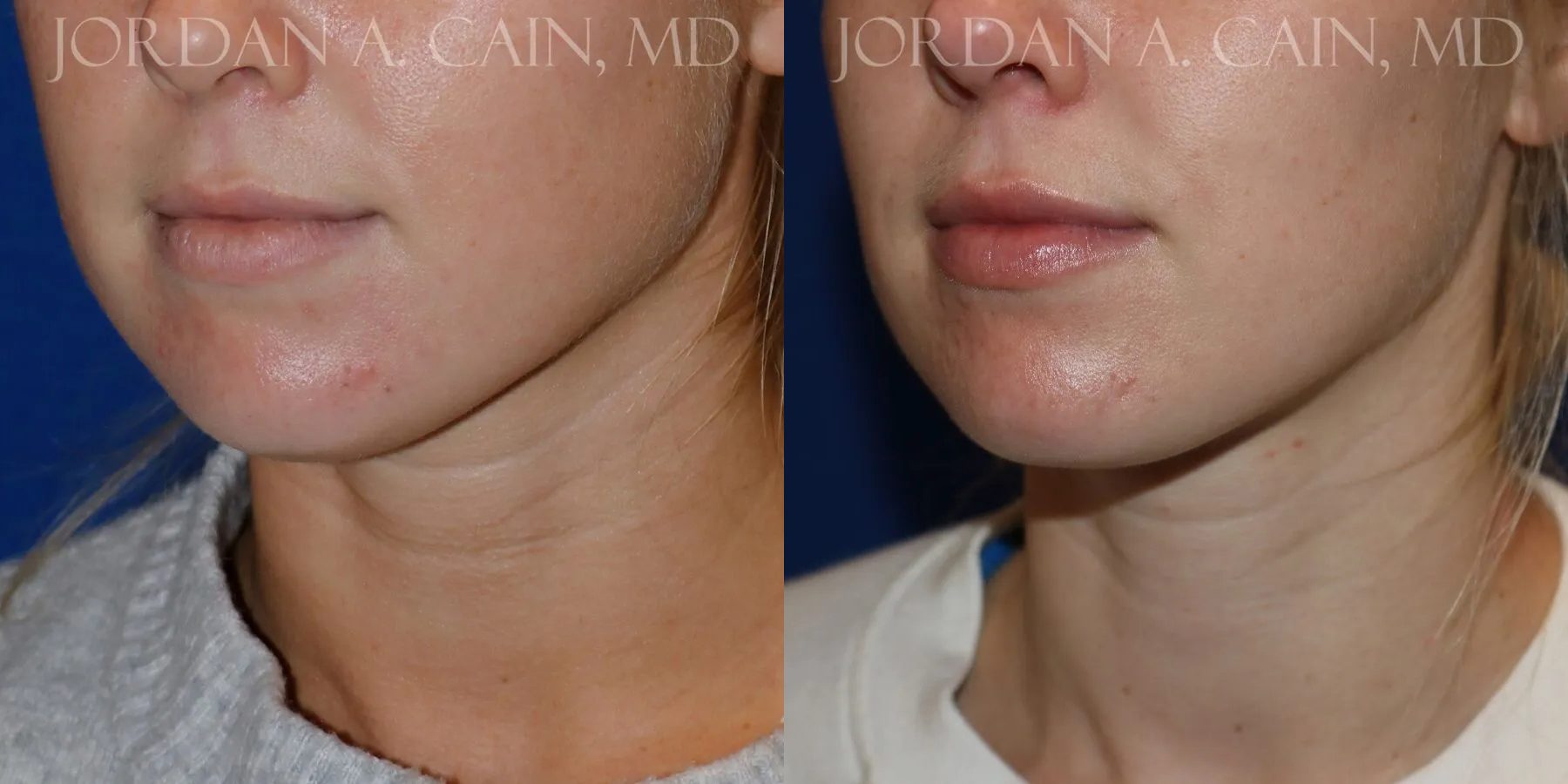 Botox Before and After photo by Texas Facial Aesthetics in Frisco, TX Botox Before and After photo by Texas Facial Aesthetics in Frisco, TX