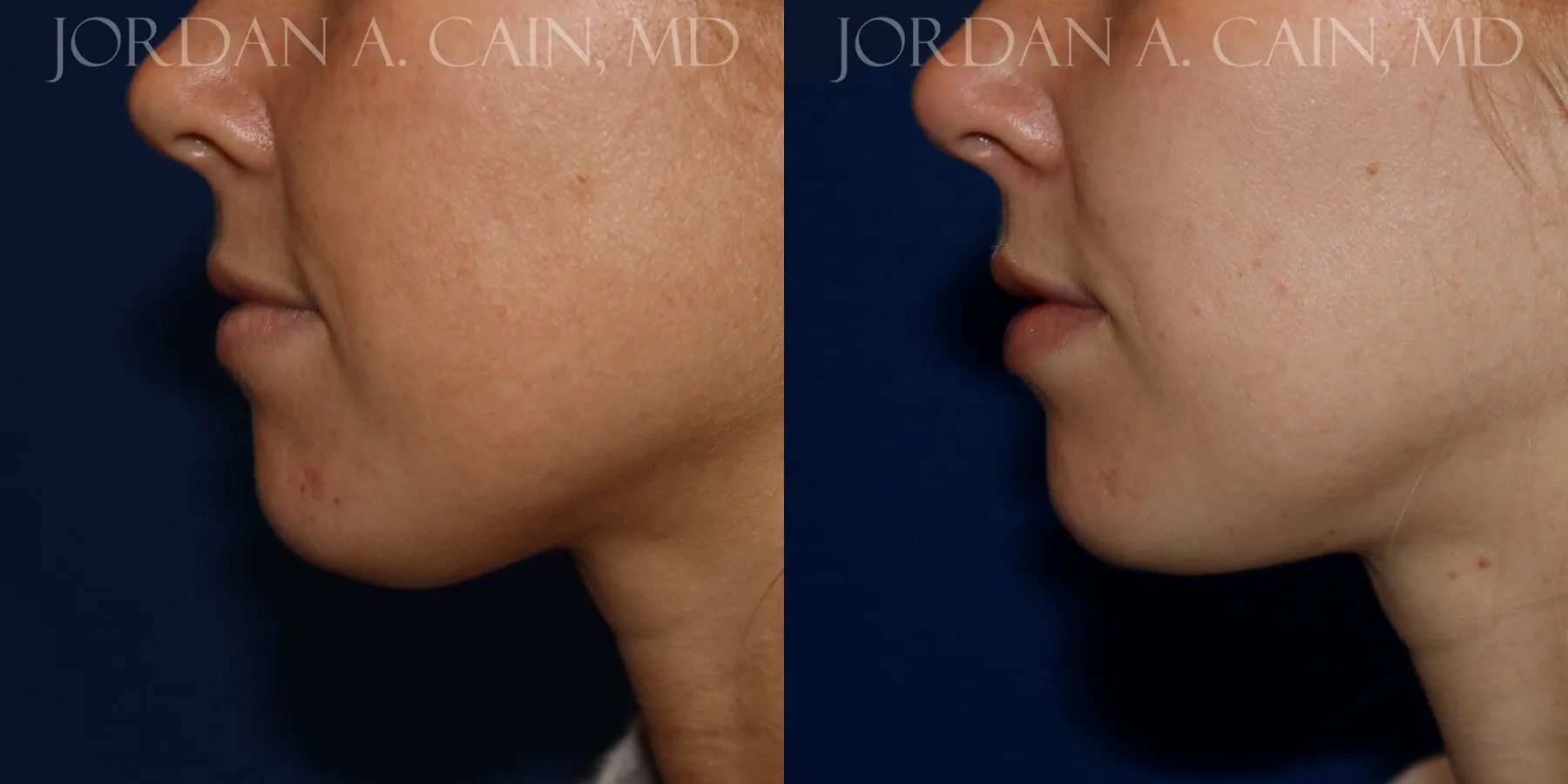 Botox Before and After photo by Texas Facial Aesthetics in Frisco, TX Botox Before and After photo by Texas Facial Aesthetics in Frisco, TX