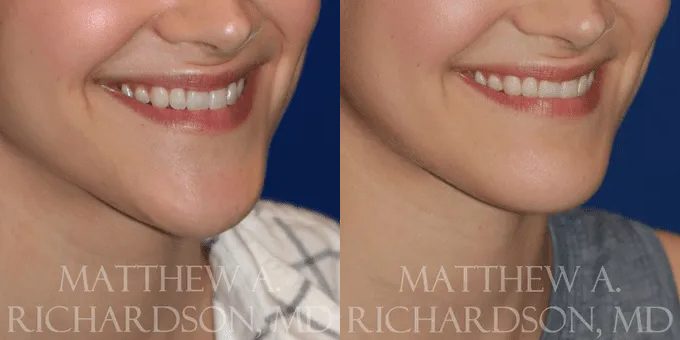 Botox Before and After photo by Texas Facial Aesthetics in Frisco, TX