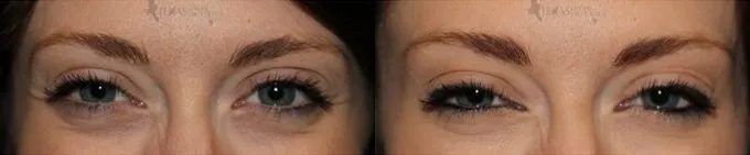 Botox Before and After photo by Texas Facial Aesthetics in Frisco, TX