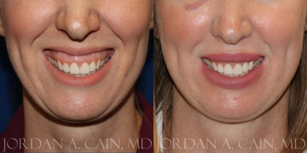 Botox Before and After photo by Texas Facial Aesthetics in Frisco, TX