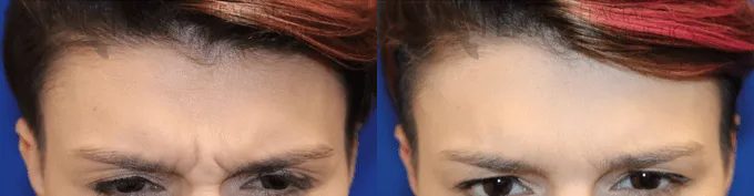 Botox Before and After photo by Texas Facial Aesthetics in Frisco, TX