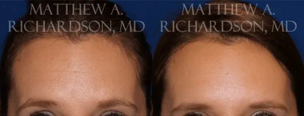 Botox Before and After photo by Texas Facial Aesthetics in Frisco, TX