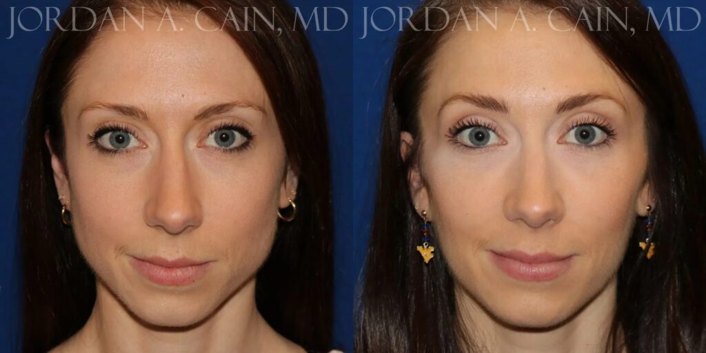 Botox Before and After photo by Texas Facial Aesthetics in Frisco, TX