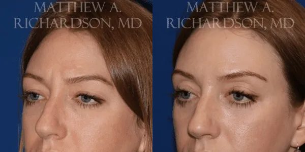 Botox Before and After photo by Texas Facial Aesthetics in Frisco, TX