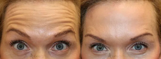 Botox Before and After photo by Texas Facial Aesthetics in Frisco, TX