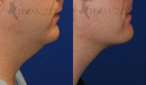 Kybella Before and After photo by Texas Facial Aesthetics in Frisco, TX