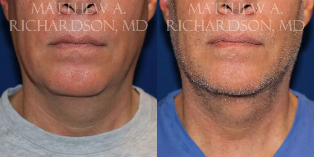 Kybella Before and After photo by Texas Facial Aesthetics in Frisco, TX
