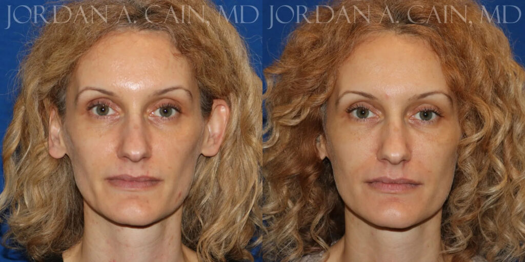 Sculptra Before and After photo by Texas Facial Aesthetics in Frisco, TX