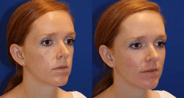 Sculptra Before and After photo by Texas Facial Aesthetics in Frisco, TX