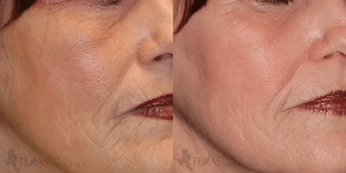 Chemical Peel Before and After photo by Texas Facial Aesthetics in Frisco, TX