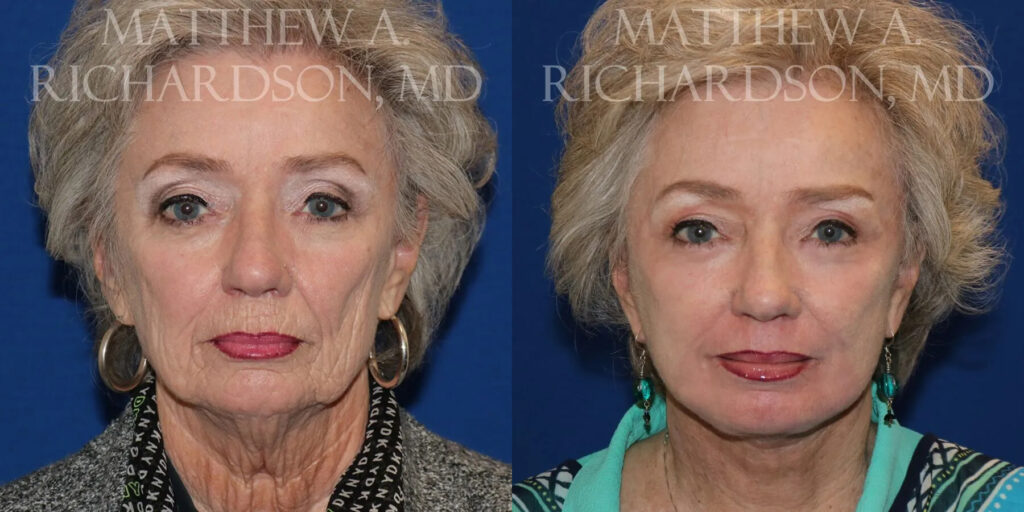 Chemical Peel Before and After photo by Texas Facial Aesthetics in Frisco, TX