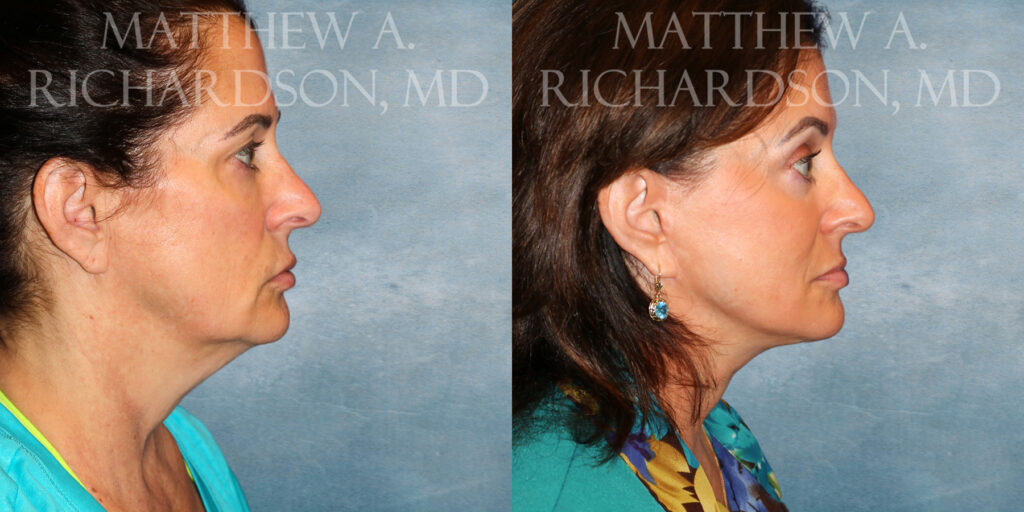 Neck Lift Before and After photo by Texas Facial Aesthetics in Frisco TX