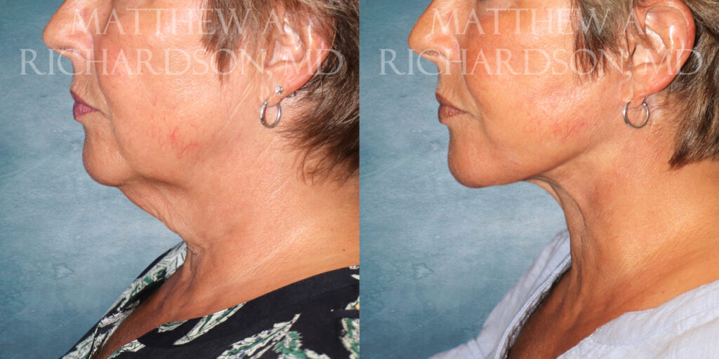 Neck Lift Before and After photo by Texas Facial Aesthetics in Frisco TX