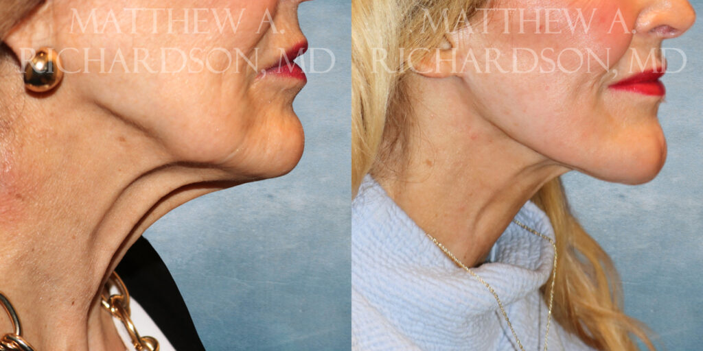 Neck Lift Before and After photo by Texas Facial Aesthetics in Frisco TX