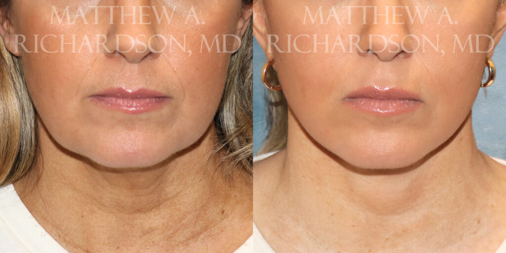Neck Lift Before and After photo by Texas Facial Aesthetics in Frisco TX