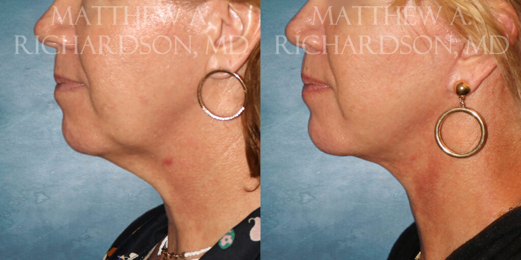 Neck Lift Before and After photo by Texas Facial Aesthetics in Frisco TX